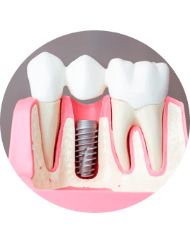 Prótesis sobre implantes