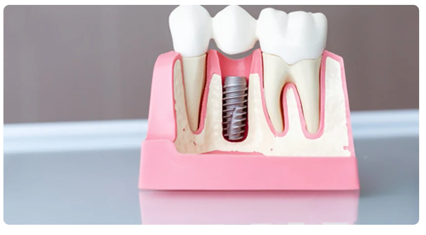 Prótesis sobre implantes