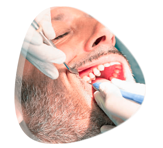 ¿Cómo saber si necesito una profilaxis dental?
