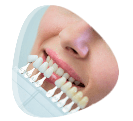 ¿Cómo se colocan las carillas de porcelana?