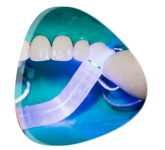 ¿Donde puedo colocarme carillas o fundas dentales?