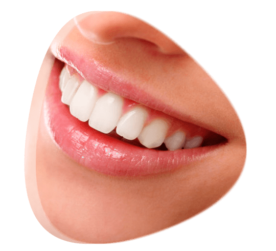 ¿Existen desventajas al tener carillas dentales?