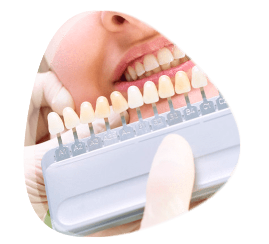 ¿Por qué se utilizan las carillas dentales de porcelana?