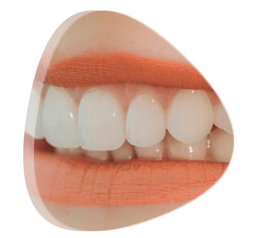 Precio de estudio de prótesis bucal en Tlalnepantla de Baz