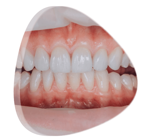 Precios de carillas y fundas dentales en México