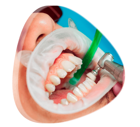 ¿Qué es la limpieza dental con ultrasonido?