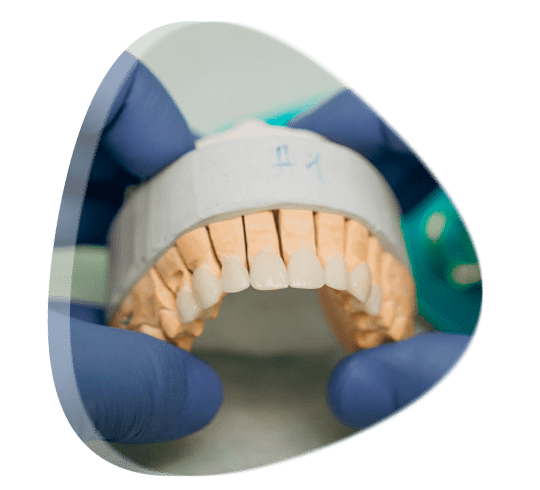 ¿Qué es mejor, las carillas o las fundas dentales?