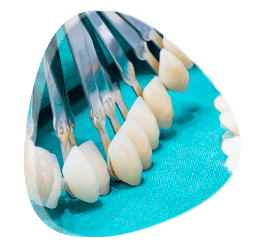 ¿Qué son las carillas dentales?