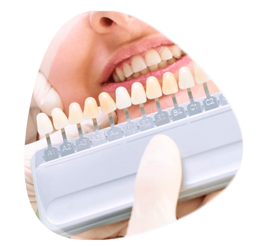 ¿Quieres conocer el costo de las carillas dentales en México?